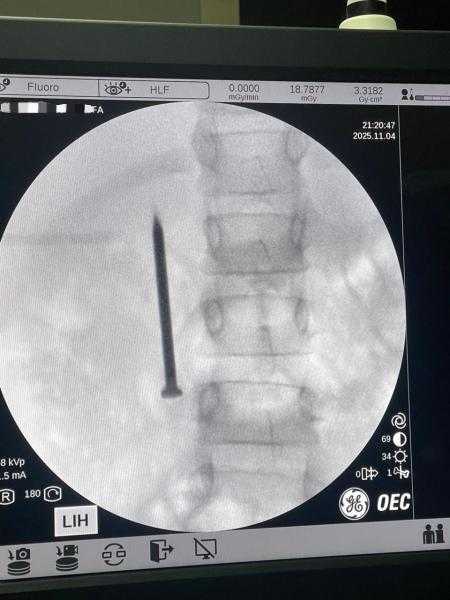 نجاح فريق طبي بمعهد الكبد القومي بجامعة المنوفية في استخراج مسمار حاد من أمعاء طفلة ٧ سنوات في 20 دقيقة