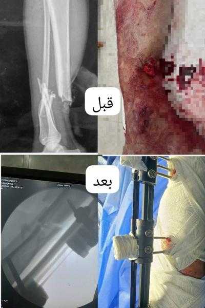 أطباء بركة السبع يحققون إنجازاً طبياً وينقذون شاباً وطفلاً من عجز مؤكد